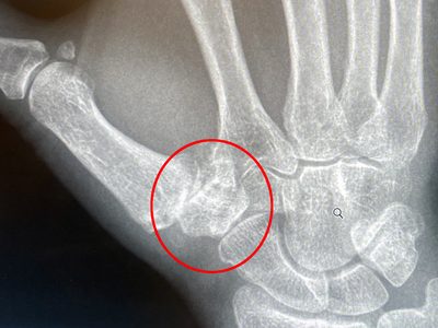 CMC arthritis in thumb